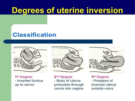 retroverted uterus in tagalog|Retroverted uterus: sanhi, sintomas at kahihinatnan .